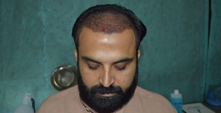 hair transplant side effects Prp hPRPair treatment lahore
