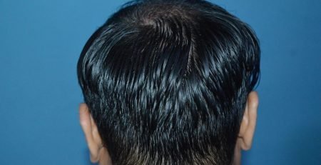 hair_transplant_islamabad