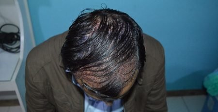 Islamabad Hair Transplant(aneels hair transplant)