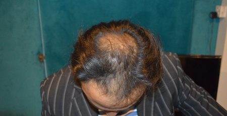 Best hair club lahore is aneels hair transplant