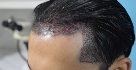 Aneels Hair Transplant(Islamabad)