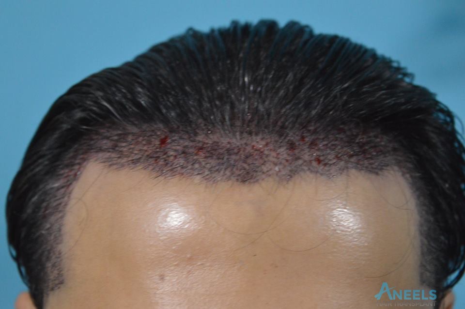 Best Hair Transplant and Hair Club in Lahore