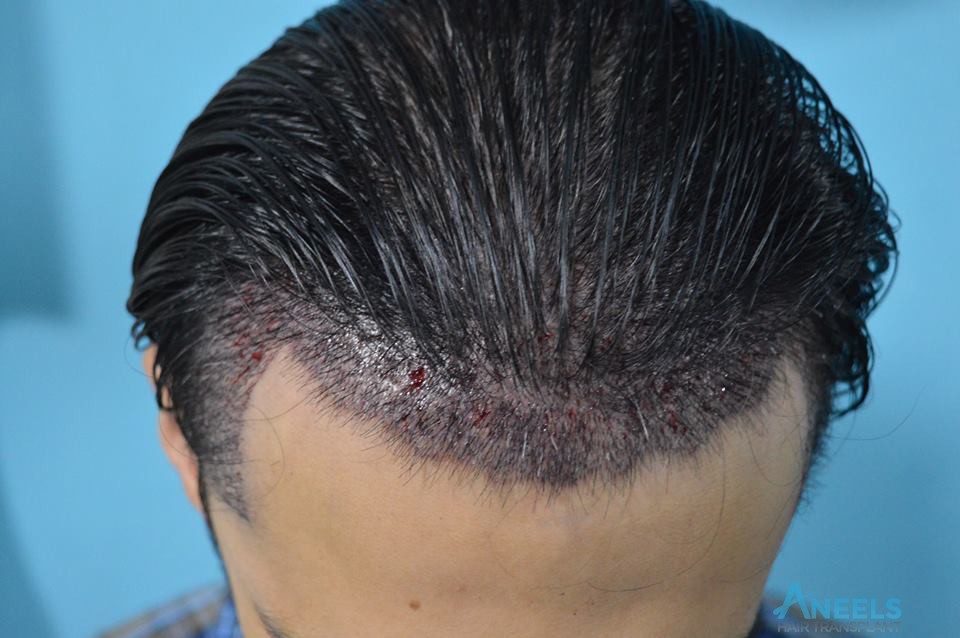 Best Hair Transplant in Lahore