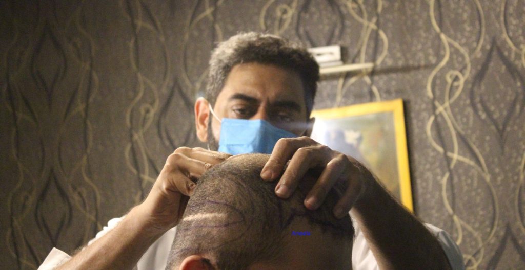 FUT Hair Transplant Lahore