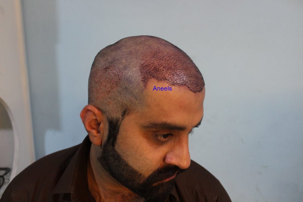 This image shows person has done FUE Hair Transplant