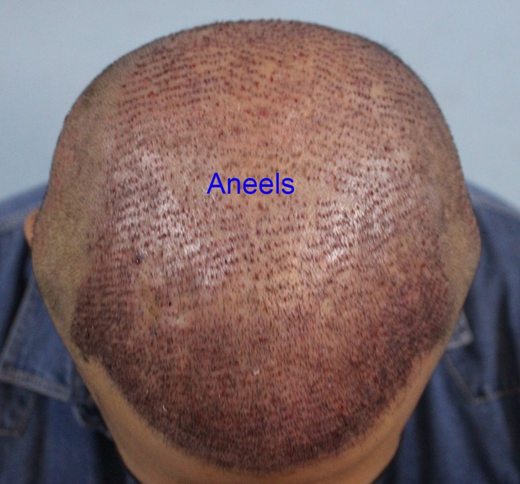 This image shows FUT Hair Transplant in Lahore