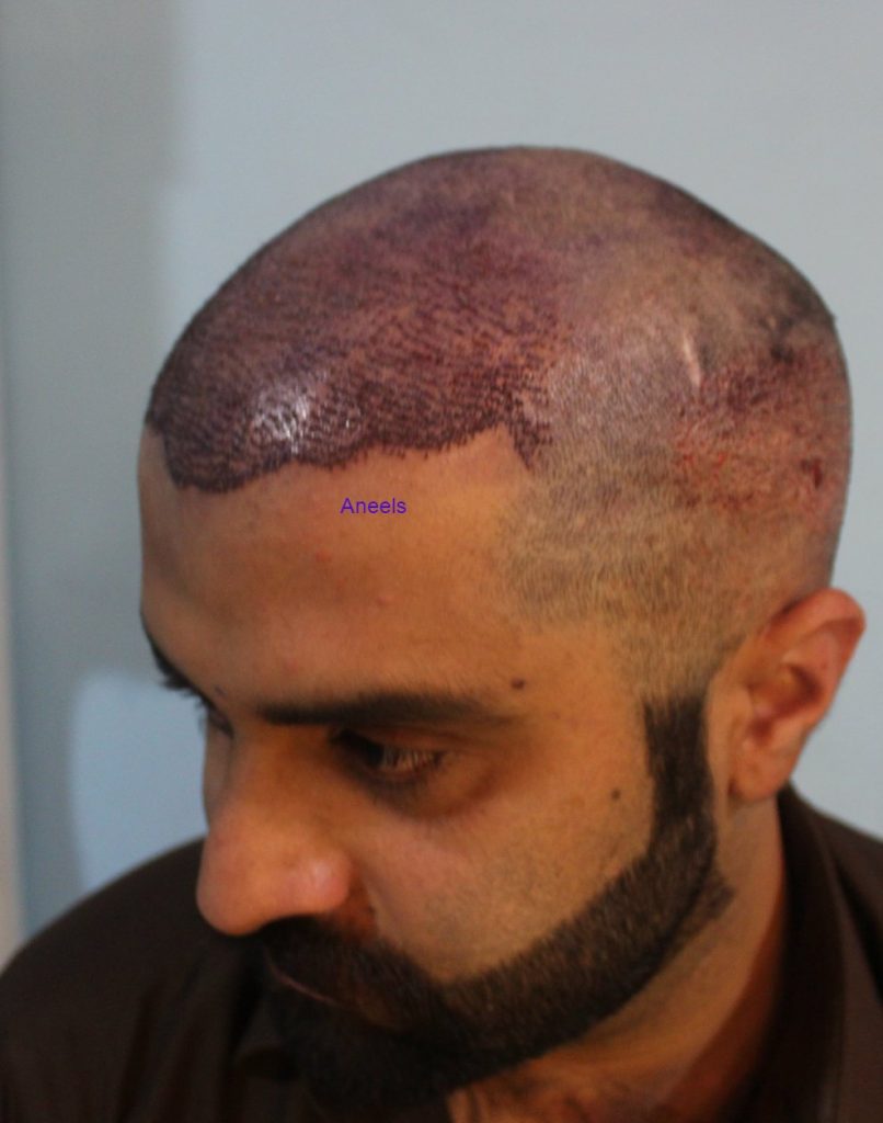 FUE Hair Transplant in Lahore