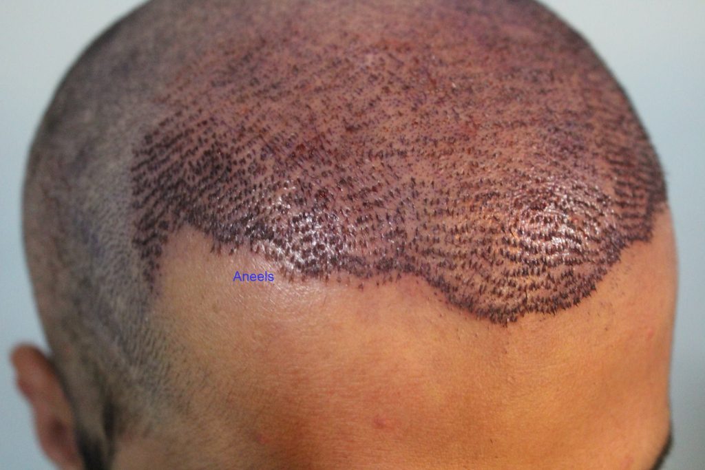 Image showing services of FUE Hair Transplant Services