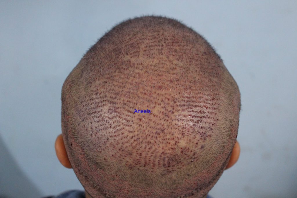 This image shows FUT Hair Transplant in Lahore