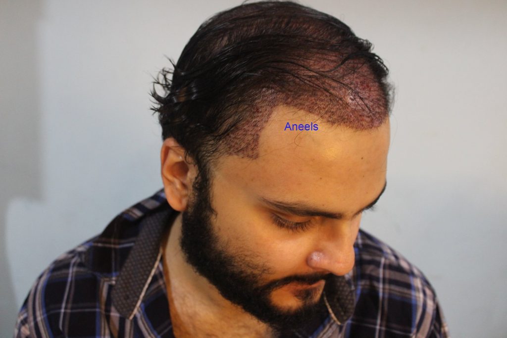 FUE Hair Transplant Lahore