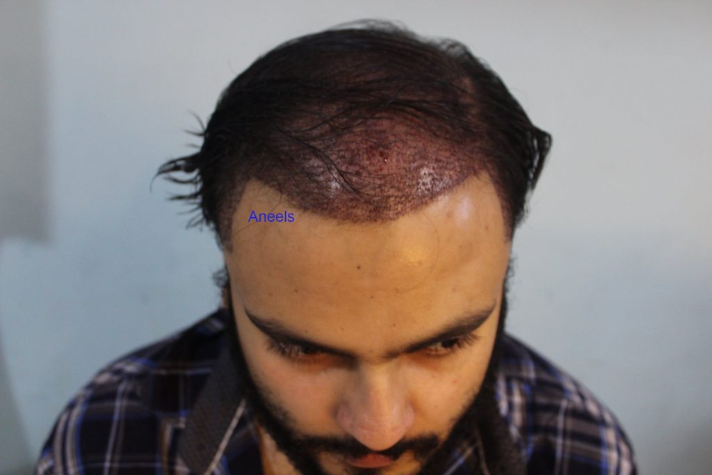 hairline design and correction in lahore