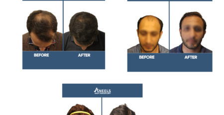 Hair Transplant Before and After Results Pictures
