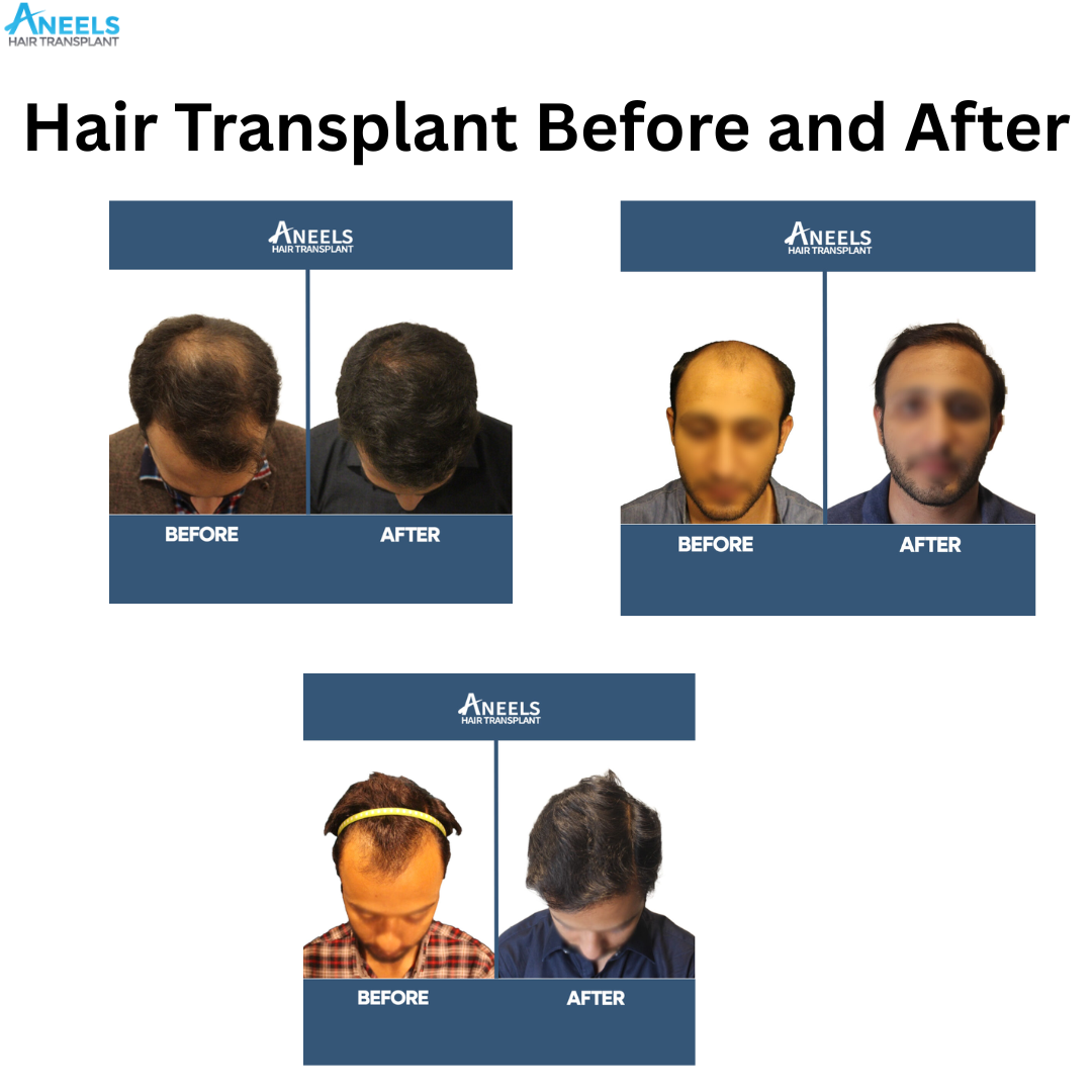 Hair Transplant Before and After Results Pictures