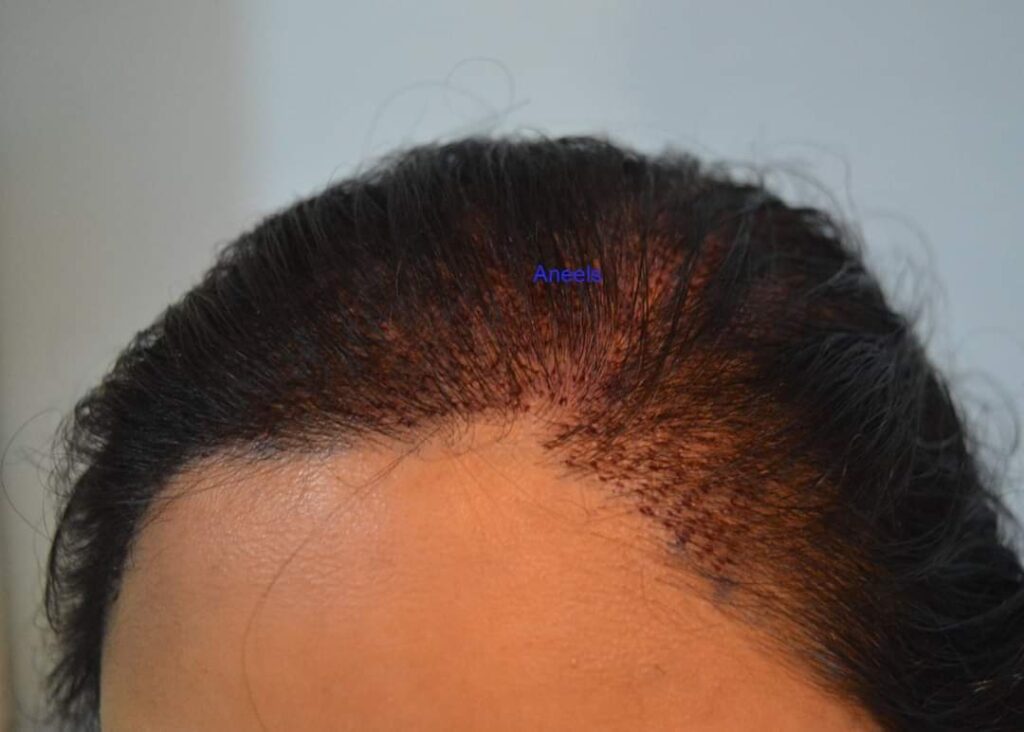 can woman take hair transplant lahore