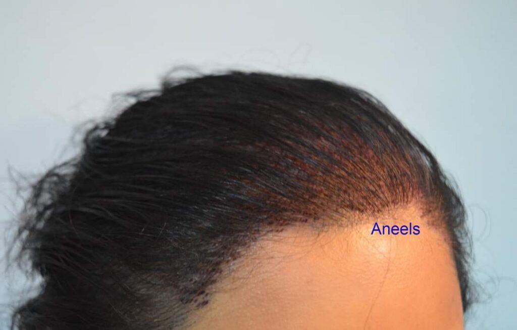 female hair transplant lahore