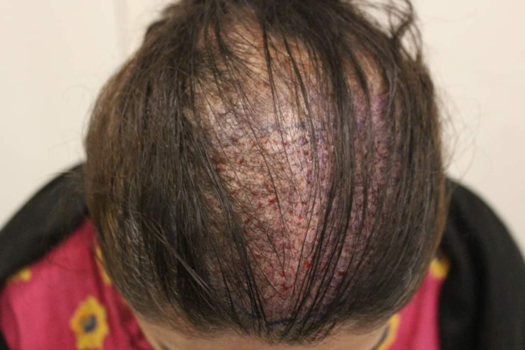 can woman take hair transplant lahore