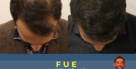 FUE Hair Transplant Lahore