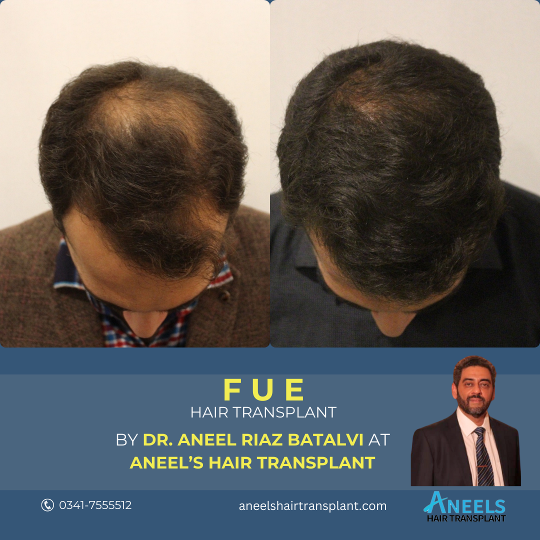 FUE Hair Transplant Lahore