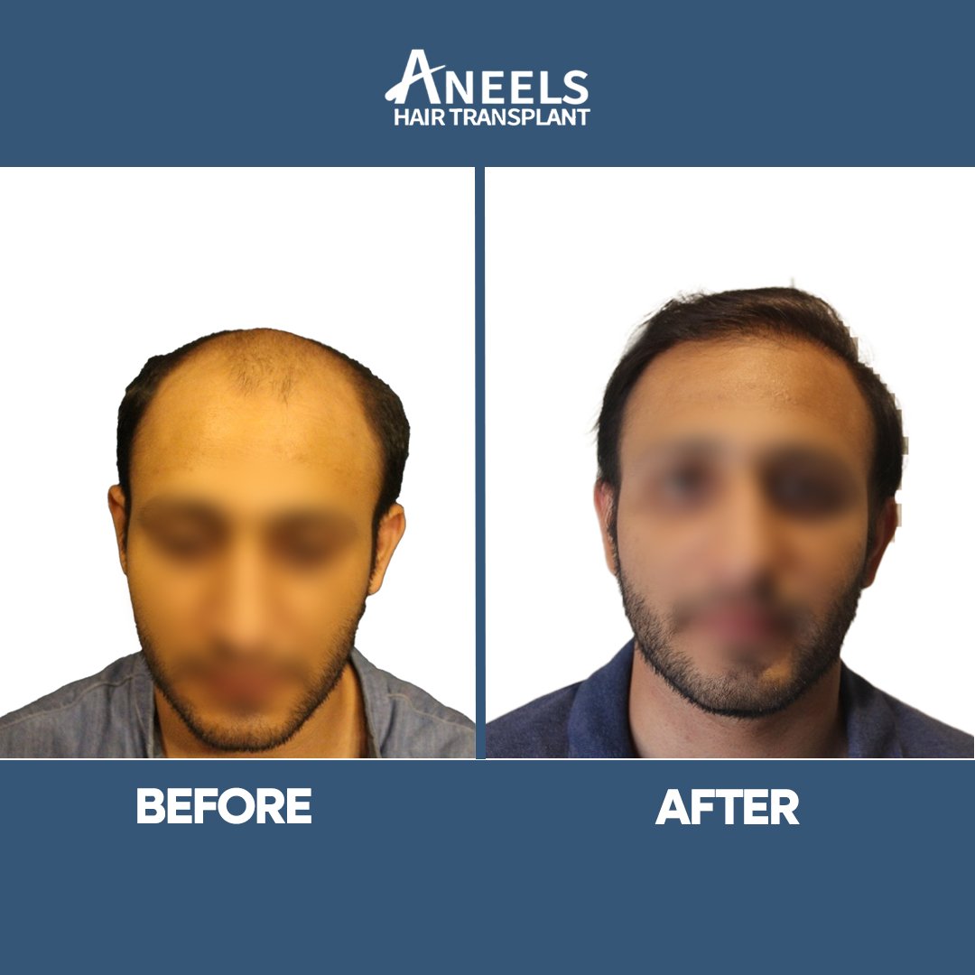 Front hairline restored, before and after views