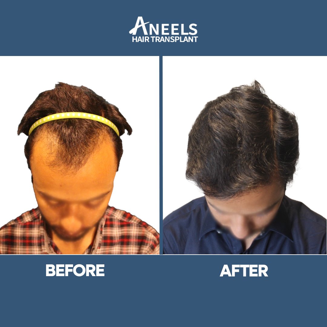 Temples thickened, shown before and after surgery