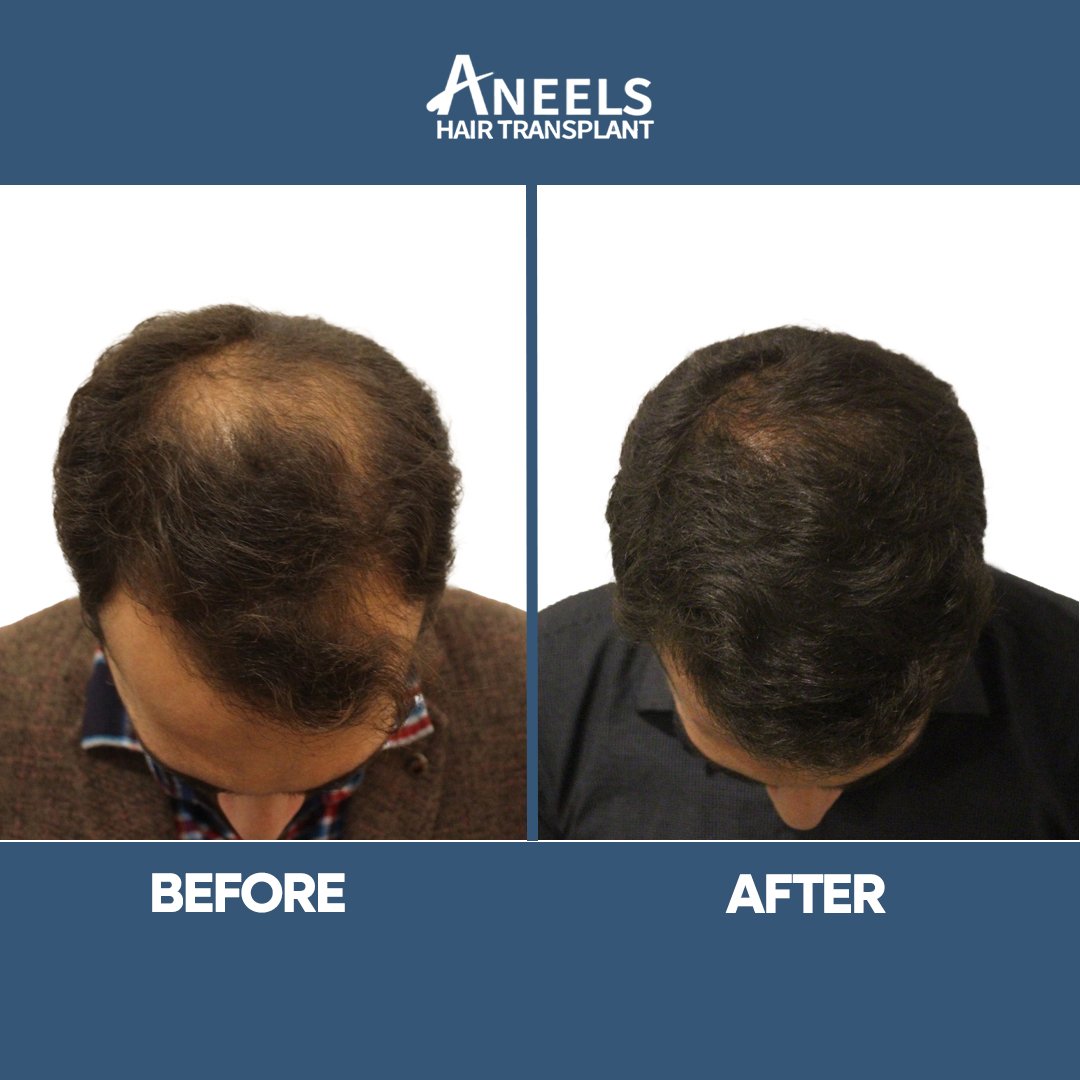 Thin crown, before treatment and after