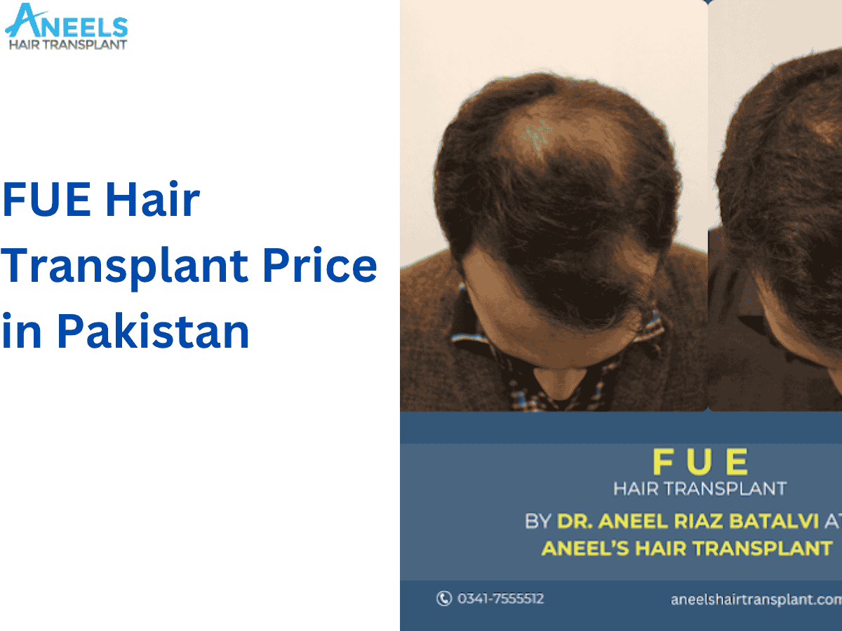 FUE Hair Transplant Price in Pakistan