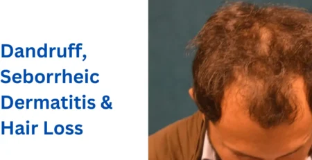 Dandruff, Seborrheic Dermatitis & Hair Loss