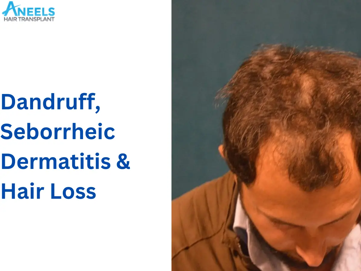 Dandruff, Seborrheic Dermatitis & Hair Loss
