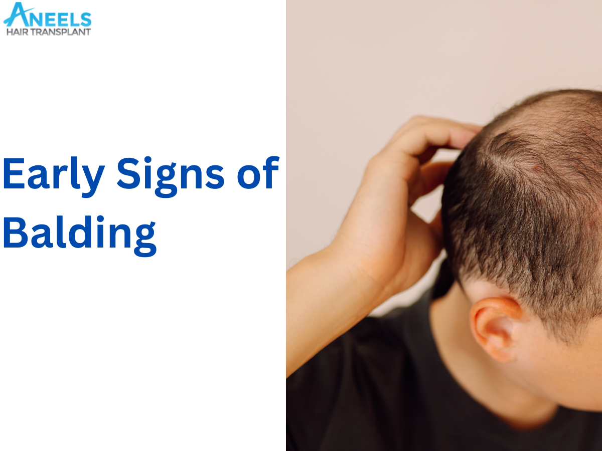 Early Signs of Balding