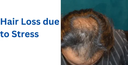 Hair Loss due to Stress