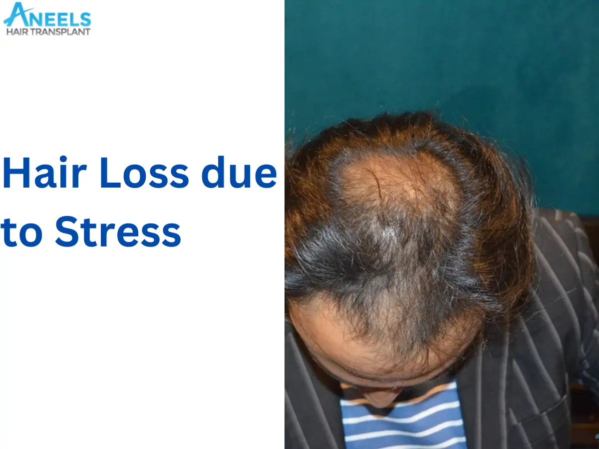 Hair Loss due to Stress