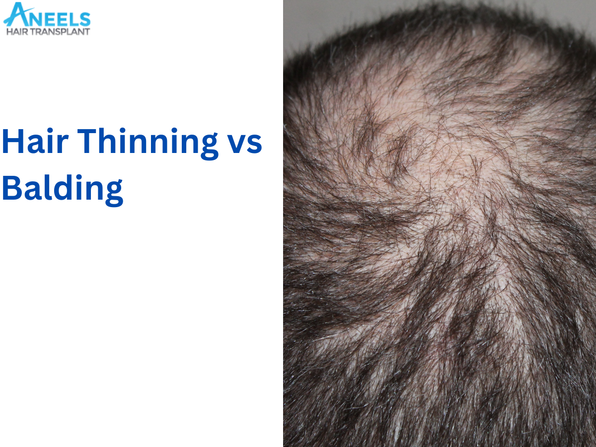 Hair Thinning vs Balding