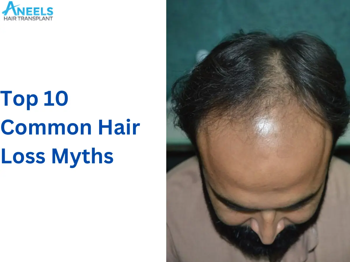 Top 10 Common Hair Loss Myths