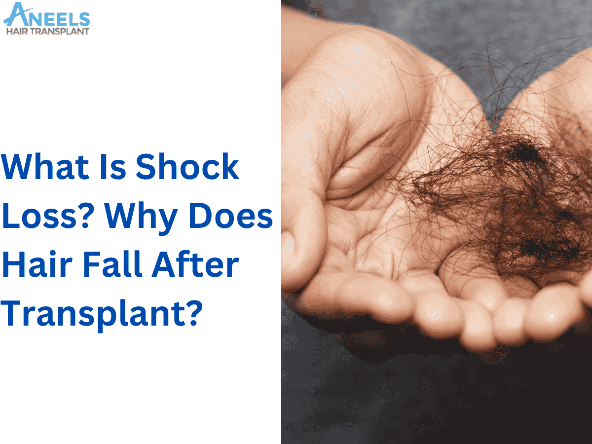 What Is Shock hair loss