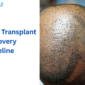 Hair Transplant Recovery Timeline