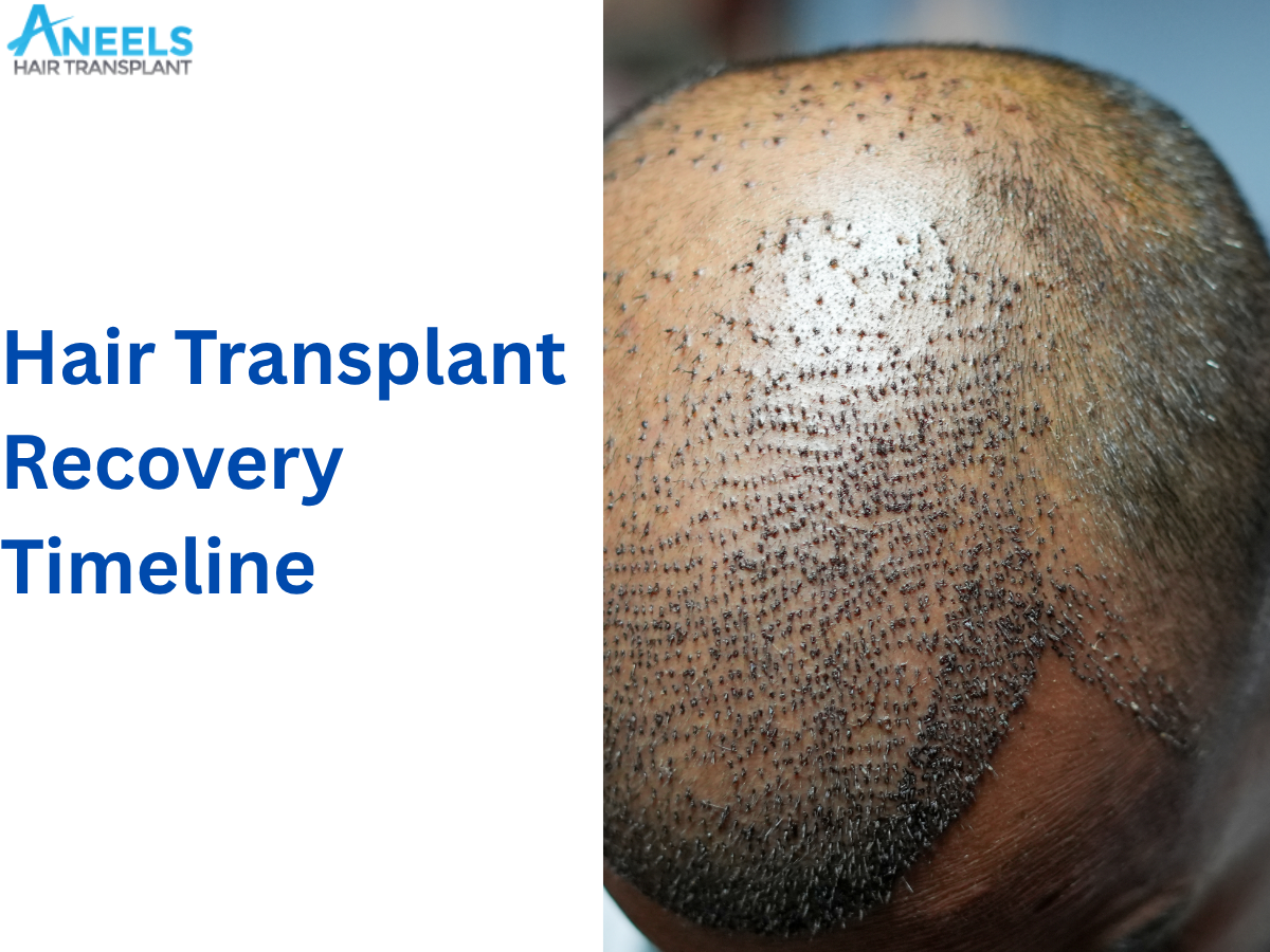 Hair Transplant Recovery Timeline