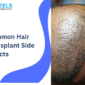 Common Hair Transplant Side Effects