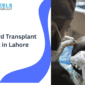 Beard Transplant Cost in Lahore