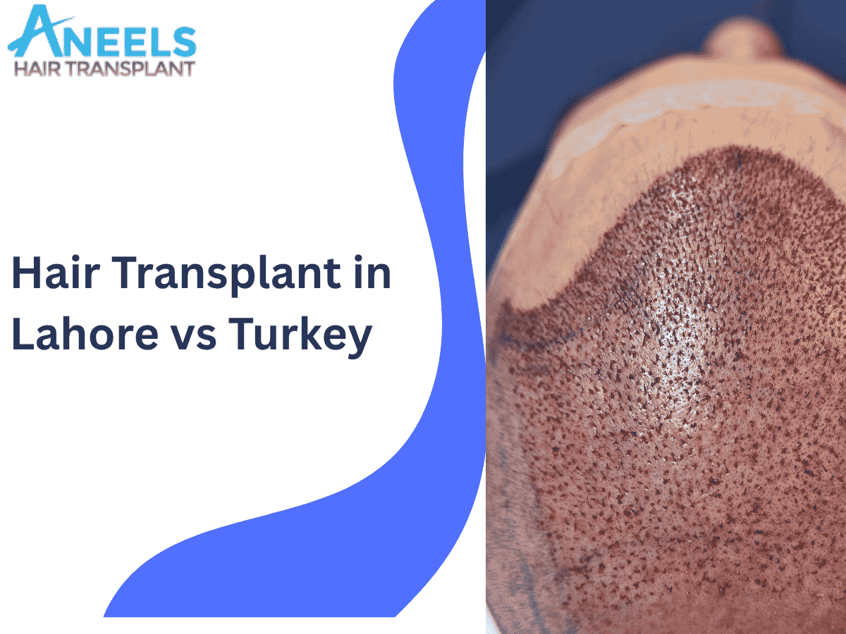 Hair Transplant in Lahore vs Turkey
