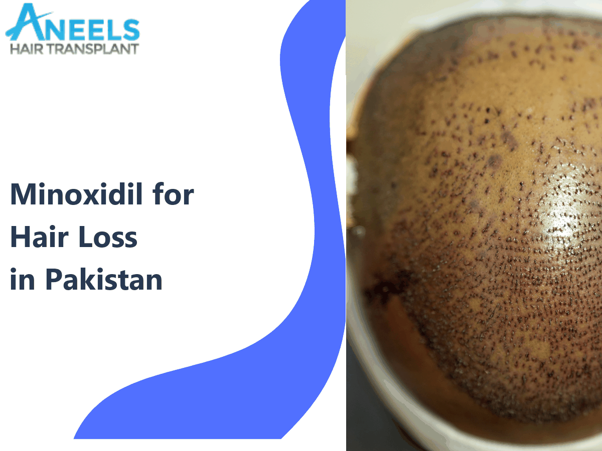 Minoxidil for Hair Loss in Pakistan: Results and Side Effects