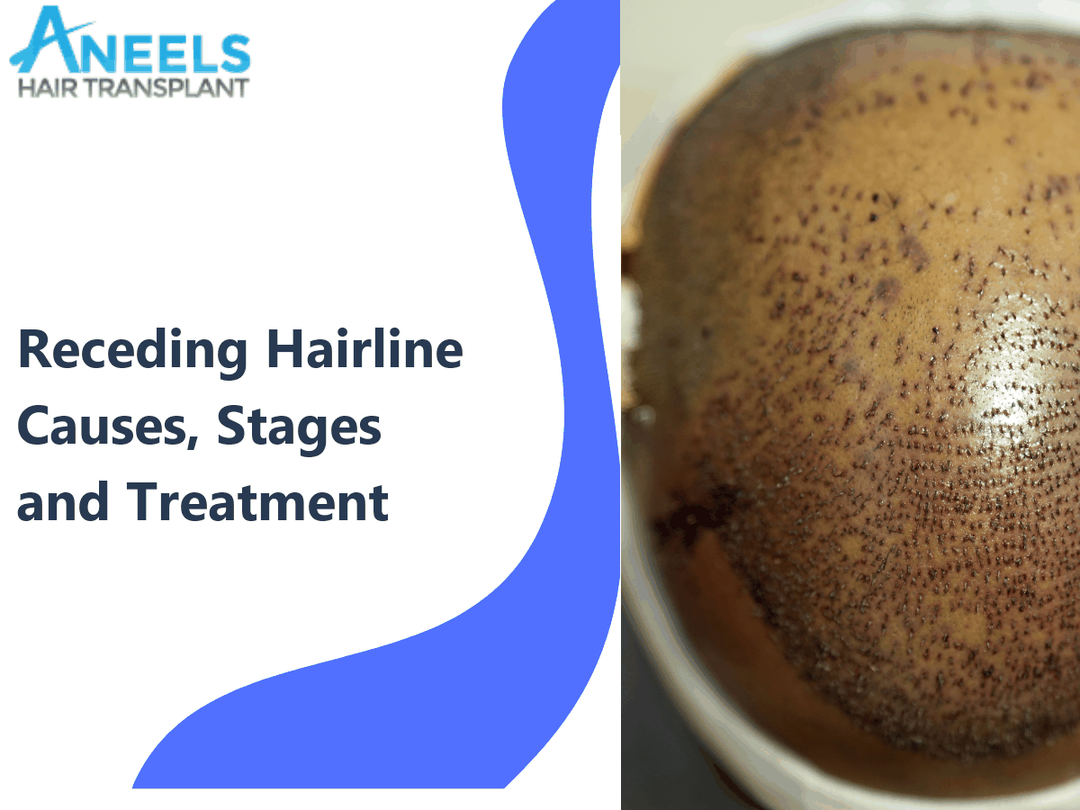Receding Hairline: Causes, Stages and Treatment Options