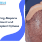 Scarring Alopecia: Causes, Treatment and Transplant Options